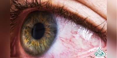 هر سال میلیون‌ها انسان دچار مشکلات چشمی می‌شوند/۵ توصیه برای سلامت چشم‌ها